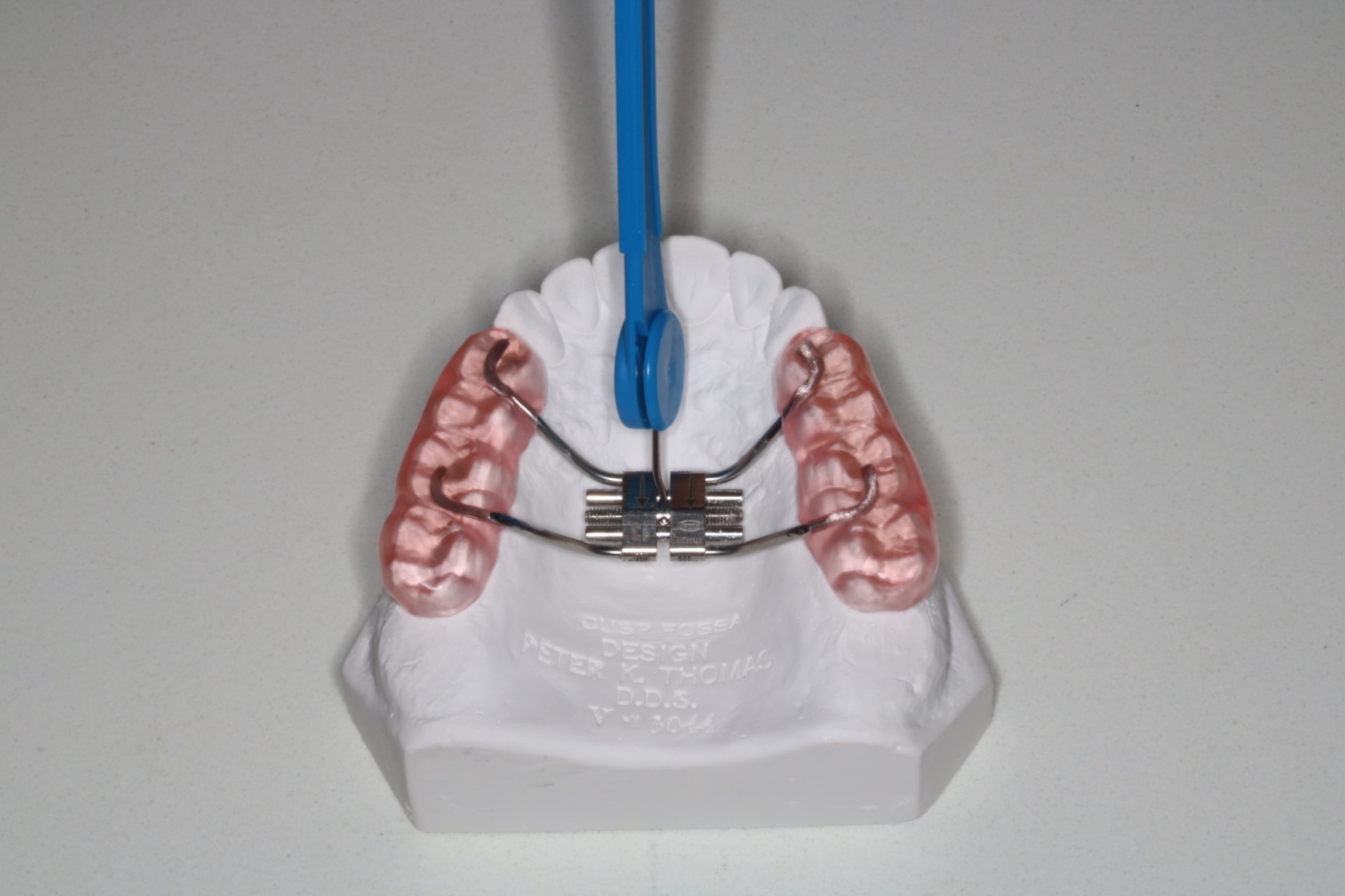 Une clé pour appareil dentaire bleue dans l’orifice de la vis.
